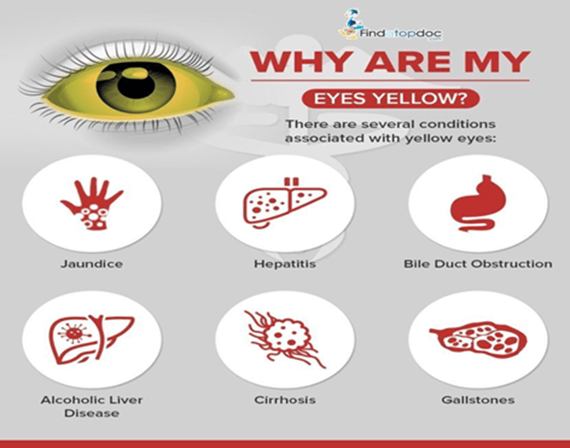 yellow spots before your eyes