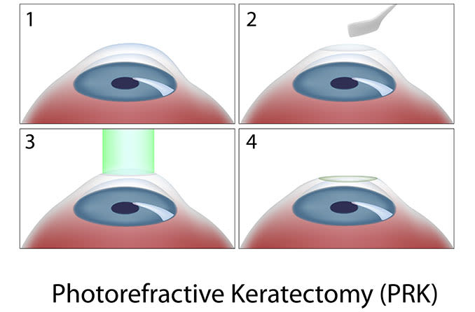 Different Types Of Corrective Eye Surgery