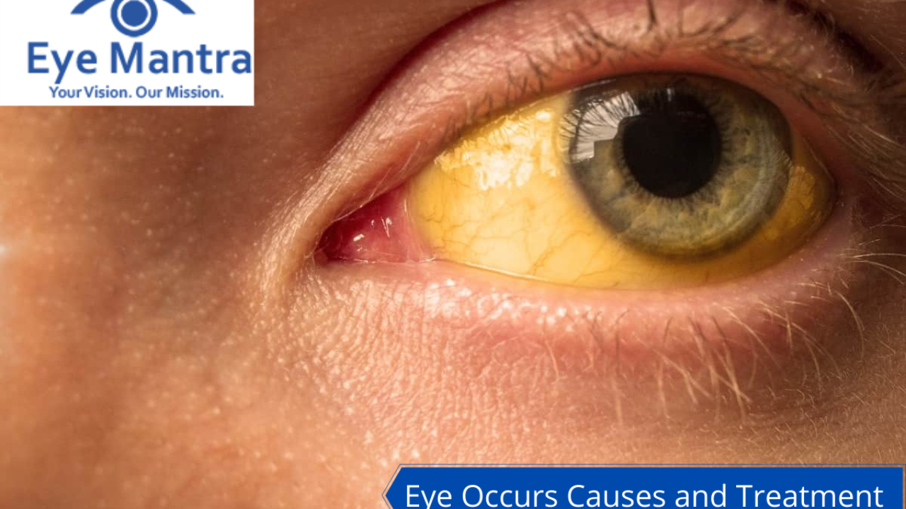 What Causes Yellow Eyes or Jaundice Eyes? Know All About This Eye