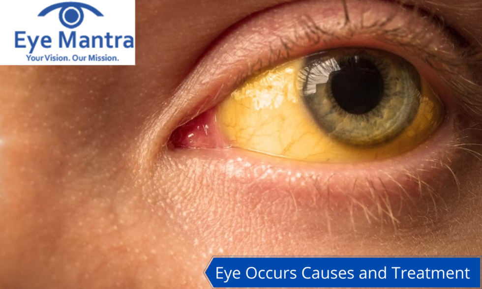 Yellow Eyes Jaundice Eyes Home Remedies And Treatment
