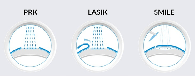 LASEK