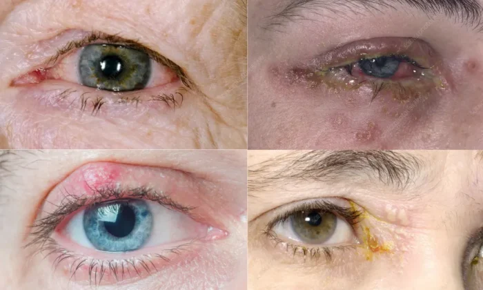 Photos of eye herpes