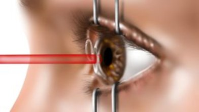 Procedure of Laser Eye Surgery 