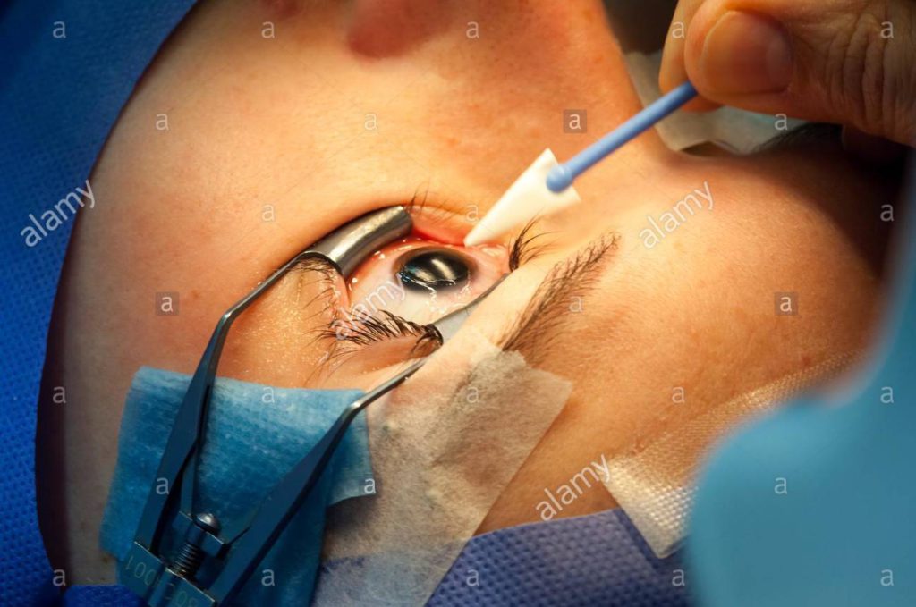 Types of corrective eye surgeries