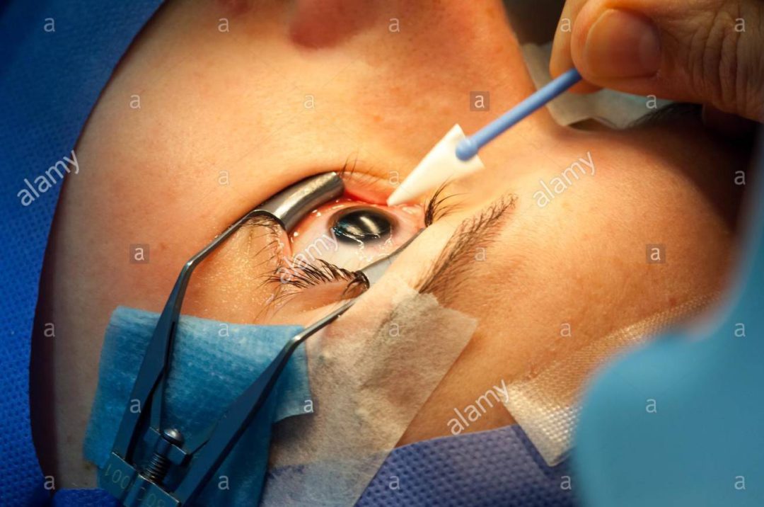 Types of Corrective Eye Surgery Laser Eye Surgery