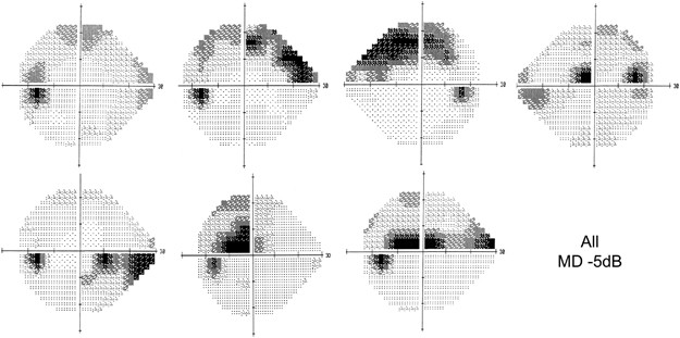 Visual field test in Glaucoma