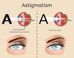 What Is Astigmatism