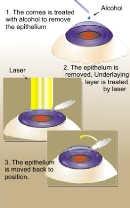 LASIK surgery