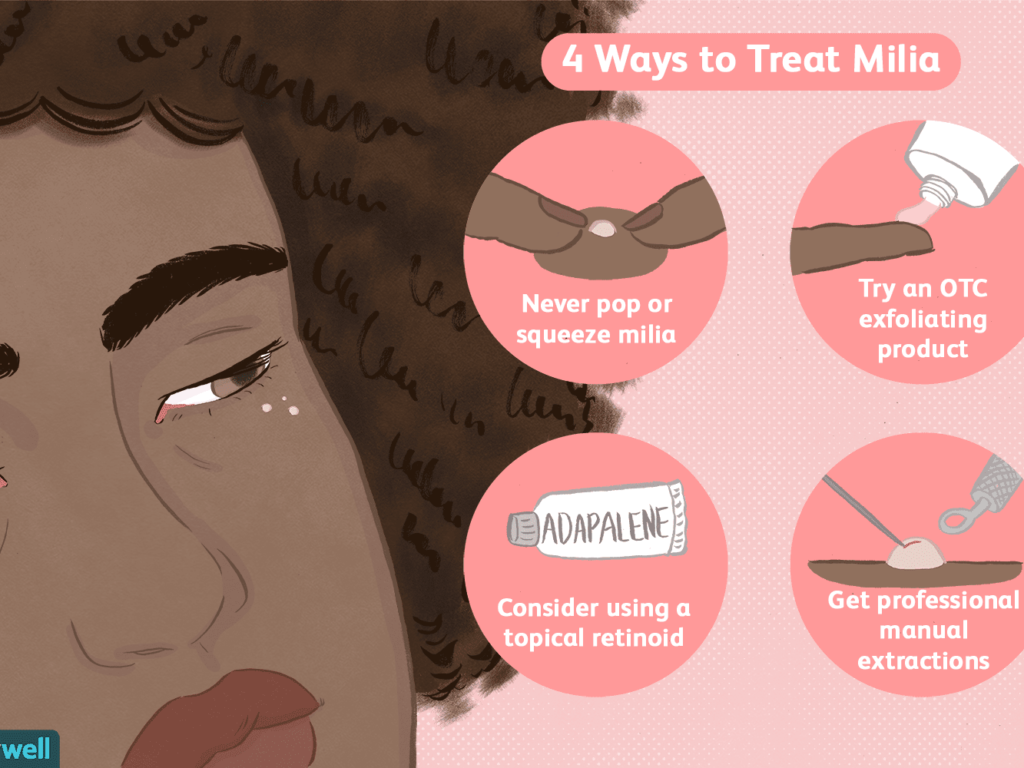 Ways to treat Milia