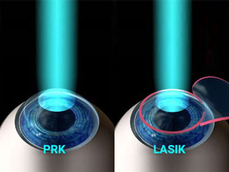 Lasik Surgery Fixing Astigmatism Side Effects