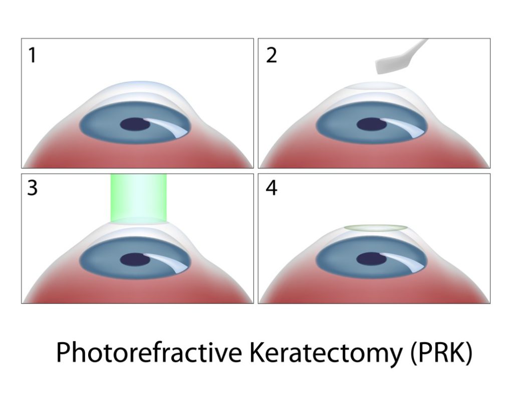 prk surgery