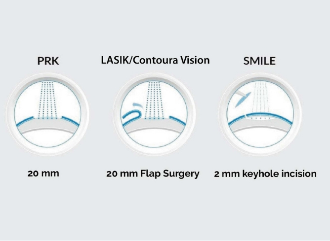 types of laser surgery- eyemantra
