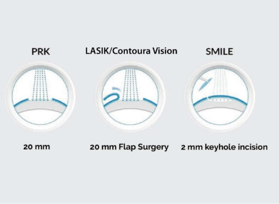 types of laser surgery- eyemantra