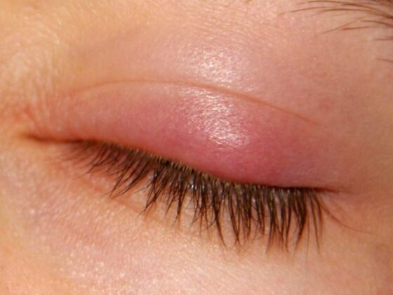 A lump on the eyelid,