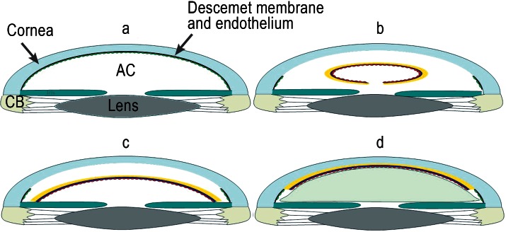 Descemet’s Stripping Endothelial Keratoplasty (DSEK)