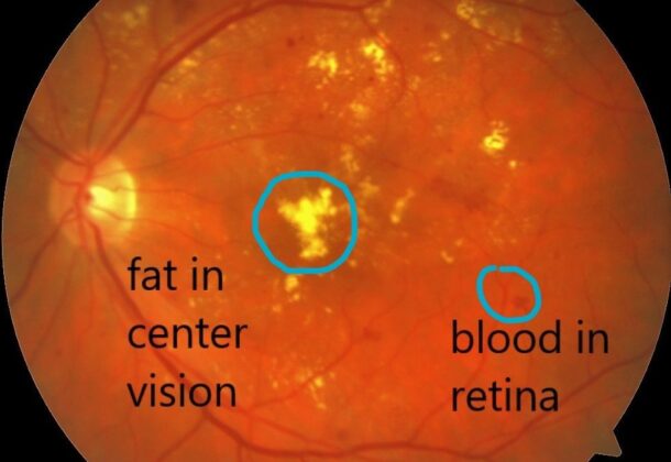 Macular edema.