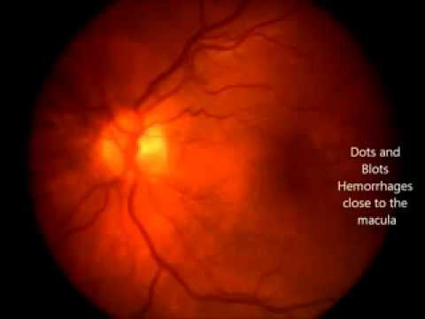 Non-proliferative diabetic retinopathy.