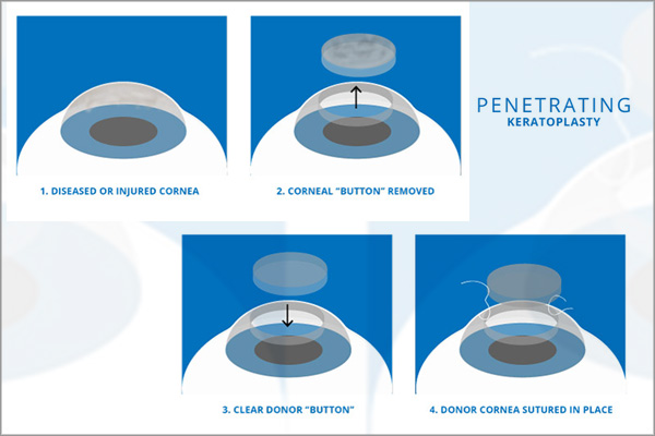 Penetrating-keratoplasty-(PK)