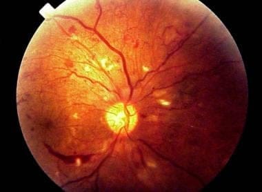 Proliferative diabetic retinopathy.