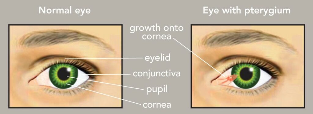 Pterygium