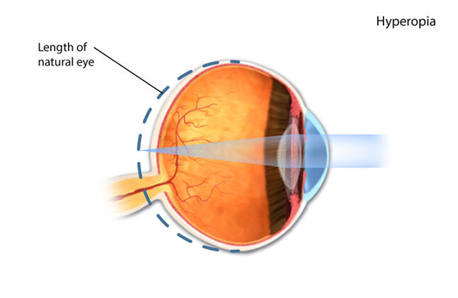 Uncorrected refractive errors.