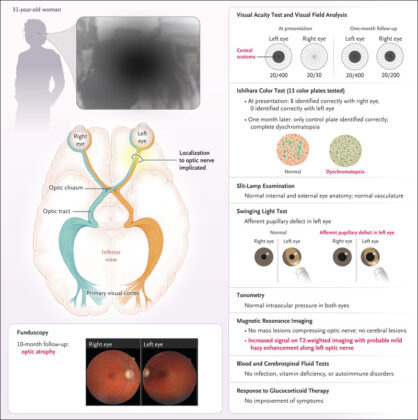 Visual Field Deficiencies