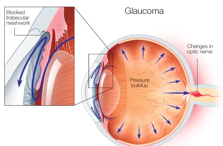 GLAUCOMA SURGERY