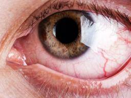 hazel-eye-with-enlarged-blood-vessels