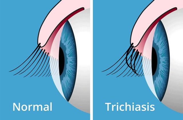 trichiasis-678x446