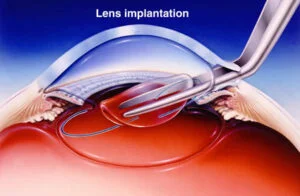 Cataract Surgery Lens Replacement