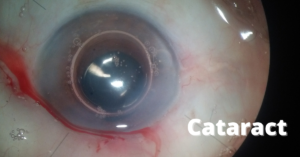 Cataract Symptoms