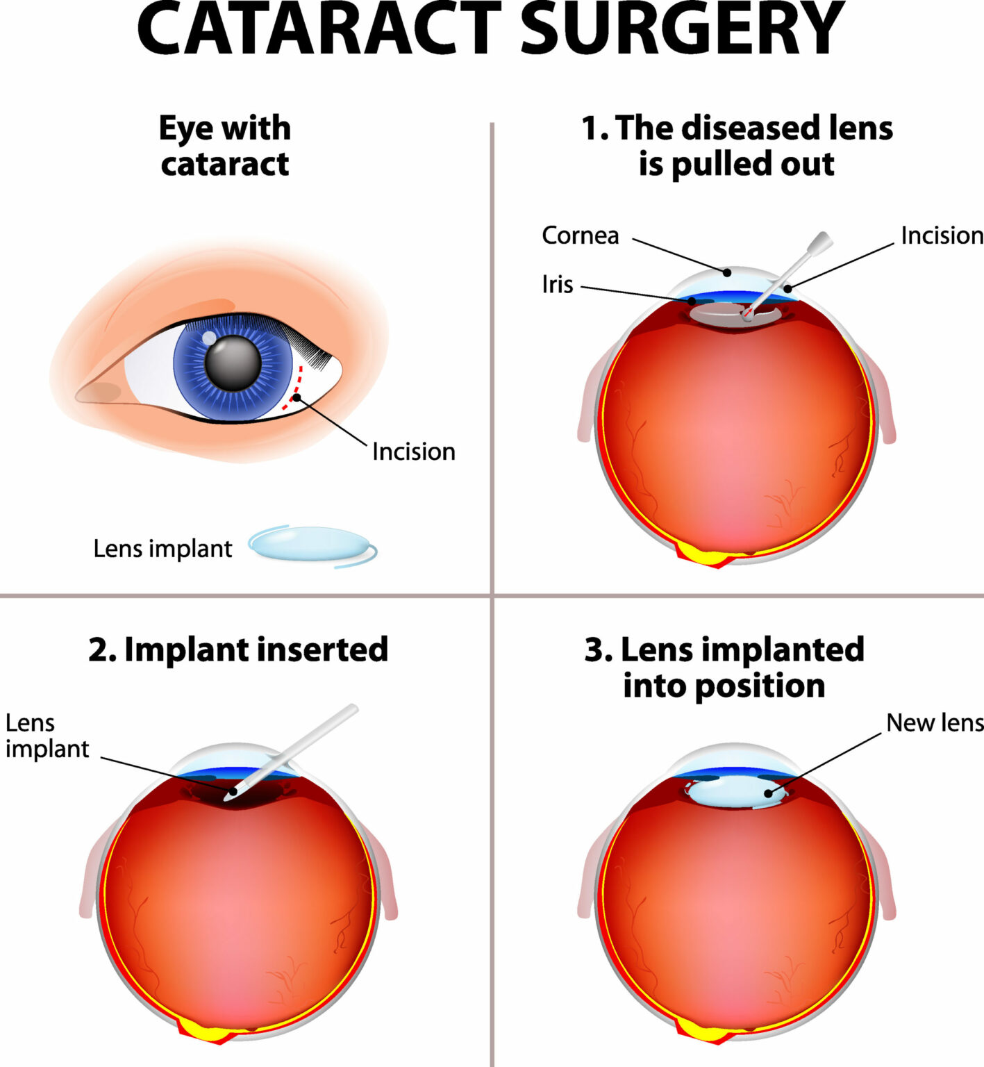 what-are-the-disadvantages-of-cataract-surgery-eyemantra