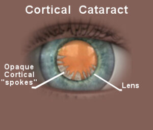 Cortical Cataract