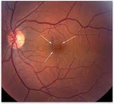 Cystoid Macular Edema (CME)