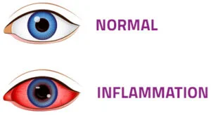 Diadvantage of Cataract Surgery