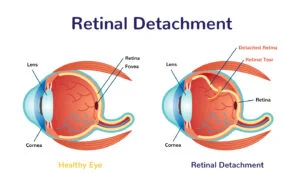 Displacement of Retina