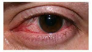  Infection: Most Common Cataract Surgery Complications