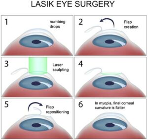 LASIK eye surgery