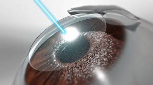 LASIK surgery