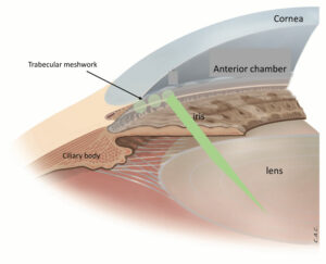 Laser Treatment for Glaucoma