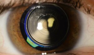 Multifocal Lens: Cataract Surgery Lens Options:
