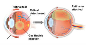 Pneumatic retinopexy damaged retina treatment