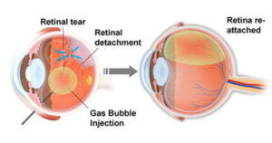 c3o8 retina surgery recovery