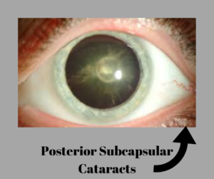 Posterior Subcapsular Cataracts