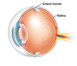 Scleral Buckling 
