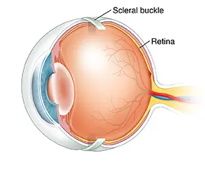 Scleral Buckling 