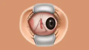 Squint Surgery