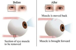 squint surgery complications