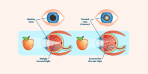 What is Cataract