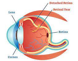 What is  Detached Retina